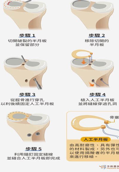 TA：腿筋4级撕裂确实存在不手术例子，埃斯特旺正在保守康复
